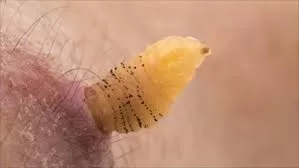 5 Insects and Parasites That Can Live Inside You: How to Detect and Prevent Them